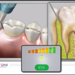 Controllo del dolore: le innovazioni nell’anestesia intraligamentosa DM_il dentista moderno_anestesia intraligamentosa