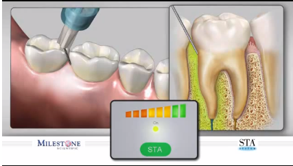 DM_il dentista moderno_anestesia intraligamentosa