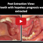 Cause e forme di fibromatosi gengivale DM_il dentista moderno_fibromatosi gengivale