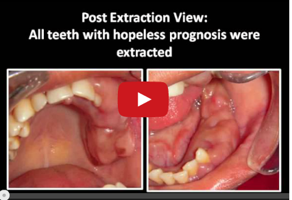 DM_il dentista moderno_fibromatosi gengivale