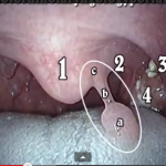 HPV: come riconoscere le manifestazioni a livello orale DM_il dentista moderno_hpv virus_papillomatosi_infezioni_condiloma verruca volgare