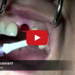 Riabilitazioni in area estetica: la zirconia in implantologia DM_il dentista moderno_implantologia_estetica_zirconia