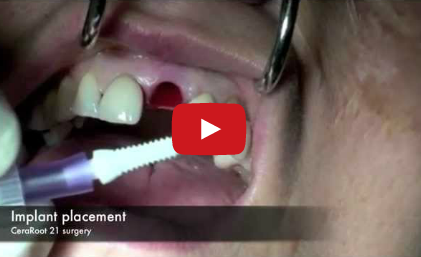 DM_il dentista moderno_implantologia_estetica_zirconia