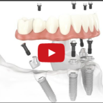 Processi a carico dell’osso in seguito ad inserimento implantare DM_il dentista moderno_inserimento implantare_osso _carico