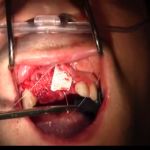 Le membrane riassorbibili e quelle space making in rigenerativa ossea guidata DM_il dentista moderno_membrane riassorbibili e non rigenerativa ossea guidata