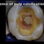 Pulpoliti: 2 diversi approcci in questi video di endodonzia DM_il dentista moderno_pulpoliti_endodonzia
