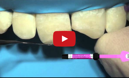 DM_il dentista moderno_ricostruzioni estetiche dirette con mascherina in silicone