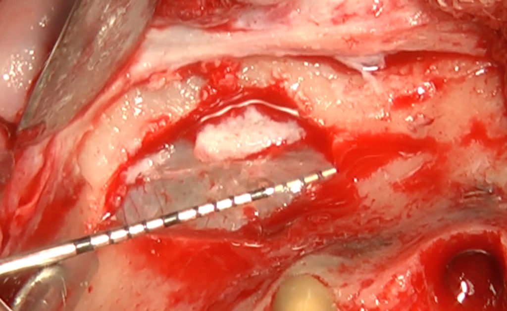 Rialzo_seno_mascellare