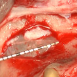 La chirurgia del Rialzo del Seno Mascellare Rialzo_seno_mascellare