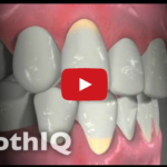 Problematiche nella diagnostica delle recessioni gengivali DM_il dentista moderno_ diagnosi delle recessioni gengivali