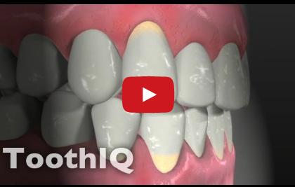 DM_il dentista moderno_ diagnosi delle recessioni gengivali