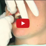 Carcinoma squamocellulare: le procedure per una completa visita di screening DM_il dentista moderno_carcinoma squamocellulare cancro visita screening