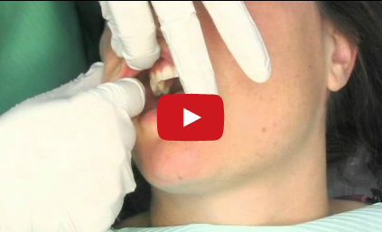 DM_il dentista moderno_carcinoma squamocellulare cancro visita screening