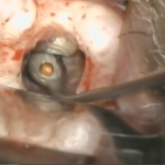 Cone Beam e terapia in endodonzia chirurgica DM_il dentista moderno_cone beam _ endodonzia chirurgica