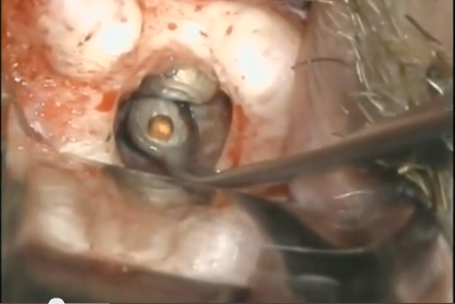 DM_il dentista moderno_cone beam _ endodonzia chirurgica