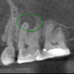 Radiotrasparenze periapicali: significato clinico e indicazioni diagnostiche DM_il dentista moderno_endodonzia_radiotrasparenze periapicali_cone beam