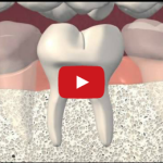 La frattura verticale di elemento dentario: classificazione e inquadramento DM_il dentista moderno_frattura verticale elemento dentario