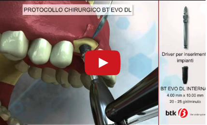 DM_il dentista moderno_impianti ad esagono esterno e interno