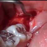 Indicazioni e controindicazioni nell’exodonzia contemporanea DM_il dentista moderno_ottavi dente del giudizio exodonzia indicazioni controindicazioni