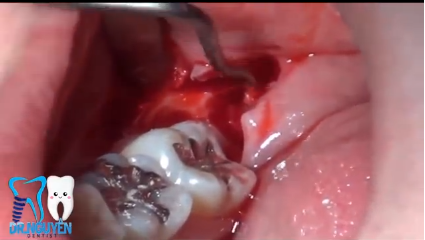 DM_il dentista moderno_ottavi dente del giudizio exodonzia indicazioni controindicazioni