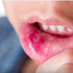 Sintomi celiachia e odontoiatria: che cosa possiamo fare? DM_il dentista moderno_sintomi celiachia odontoiatria