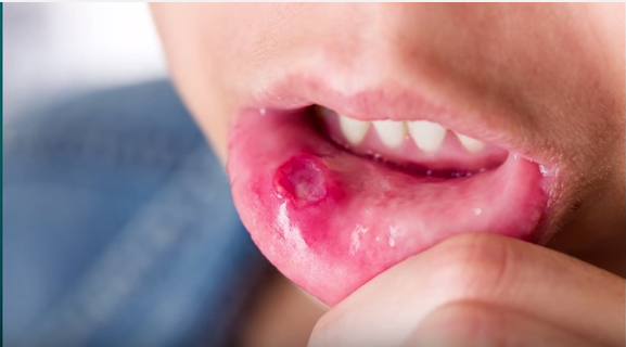 DM_il dentista moderno_sintomi celiachia odontoiatria