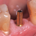 La corona a pontic nella moderna protesi su impianti