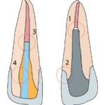 Trattamento post-endodontico con cemento resina composito e perno in fibra