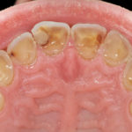 Faccette palatali in composito per la riabilitazione di un caso di grave erosione dentale, odontoiatria da minimamente invasiva a non invasiva: un case report con follow-up a 5 anni