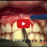Gummy smile o sorriso gengivale: la soluzione chirurgica DM_il dentista moderno_gummy smile sorriso gengivale