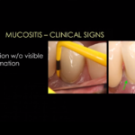 Fattori di rischio di infiammazione dei tessuti perimplantari DM_il dentista moderno_infammazione tessuti perimplantari