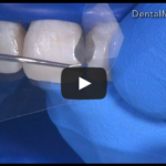 Odontoiatria restaurativa conservativa: fattore C e stress da contrazione DM_il dentista moderno_odontoiatria restaurativa conservativa_fattore c stress contrazione