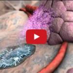 Aggiornamenti clinico-scientifici sull’osteonecrosi dei mascellari da bifosfonati DM_il dentista moderno_odontoiatria_bifosfonati