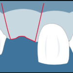 Parodontologia e gestione dei tessuti molli: roll flap DM_il dentista moderno_parodontologia roll flap