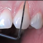 Parodontologia: eziologia delle recessioni gengivali DM_il dentista moderno_parodontologia_eziologia delle recessioni gengivali