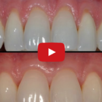 Recessioni gengivali: fattori predisponenti DM_il dentista moderno_recessione gengivale fattori predisponenti