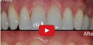 DM_il dentista moderno_recessione gengivale fattori predisponenti