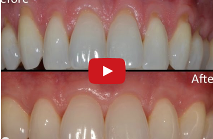 DM_il dentista moderno_recessione gengivale fattori predisponenti