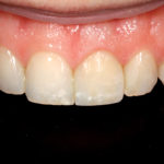 Faccette dirette in composito come prevenzione della discolorazione dopo lo sbiancamento di denti non vitali Case report