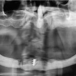 Riabilitazione orale implantologica e complicanze chirurgiche