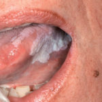 Guida pratica alle leucoplachie