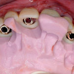 Protesi fissa a supporto implantare mediante funzione immediata