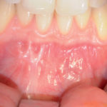 Trattamento chirurgico di un’estesa cisti aneurismatica mandibolare: un case report