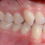 Valutazione della prevalenza dei differenti tratti malocclusivi: revisione della letteratura