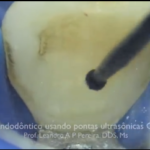 Riassorbimento radicolare esterno in ortodonzia DM_il dentista moderno_Riassorbimento radicolare esterno in ortodonzia