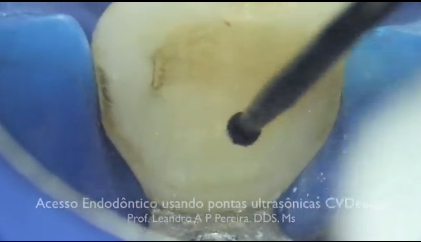 DM_il dentista moderno_Riassorbimento radicolare esterno in ortodonzia