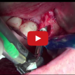 Frattura impianto dentale: affrontare le complicanze in implantologia DM_il dentista moderno_frattura impianto dentale complicanze in implantologia