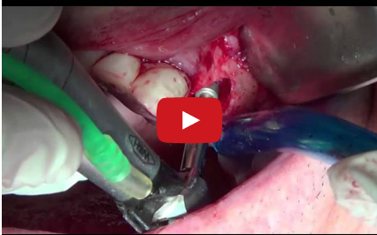 DM_il dentista moderno_frattura impianto dentale complicanze in implantologia