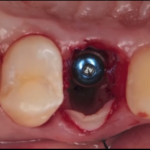 Siti infetti: Impianti postestrattivi e provvisorizzazione immediata