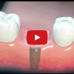 Implantologia: come trasmettere informazioni adeguate e precise al paziente DM_il dentista moderno_implantologia_paziente_informazioni